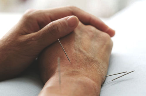 Brisbane Natural Therapy - Acupuncture