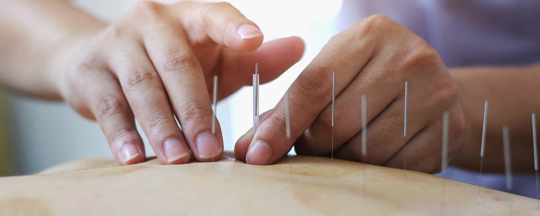Recommended Acupuncture Schedule For Pregnancy Paddington Clinic Brisbane